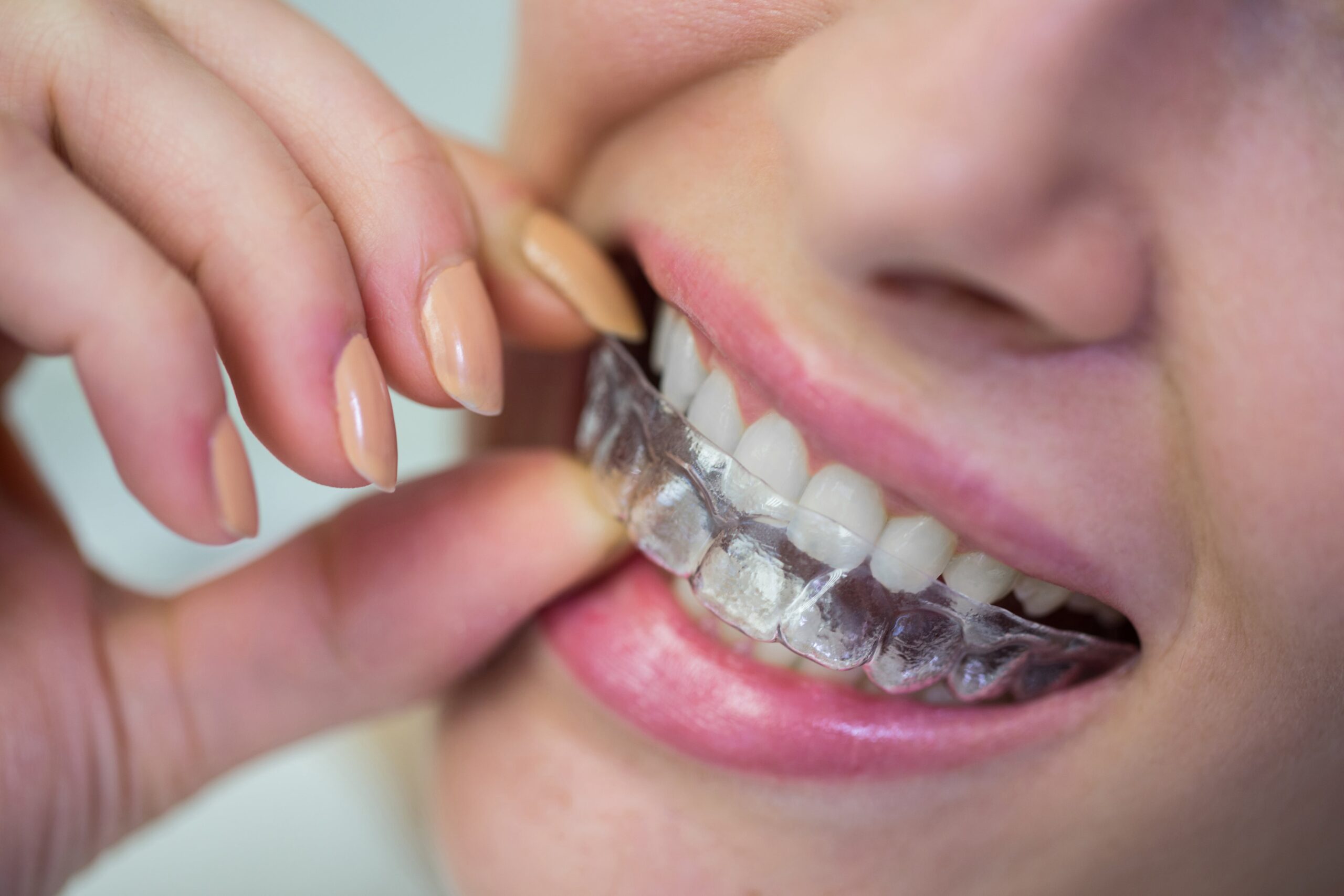 The Top 7 Benefits of Choosing Invisalign Over Traditional Braces